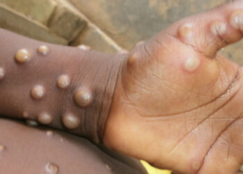 ฝีดาษลิง ที่จริง ๆ ไม่ได้ระบาดจากลิง